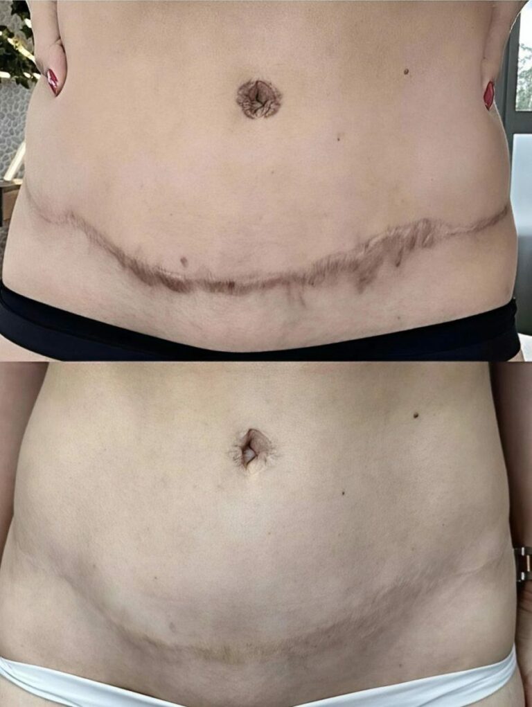 Après une abdominoplastie : la cicatrice, et la suite